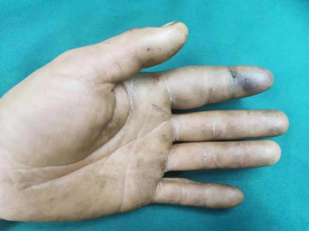 注意！手指被柴油“射”中，一船員差點要被截指！